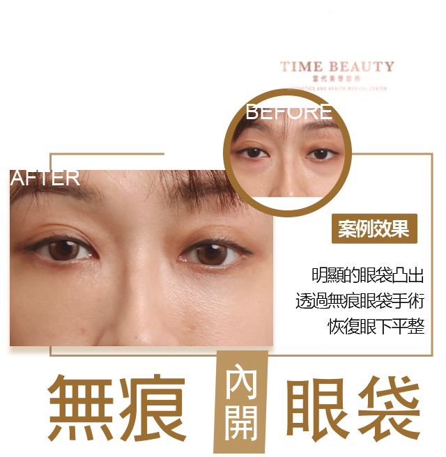 眼袋手術案例 ，眼袋手術費用，眼袋內開，眼袋dcard